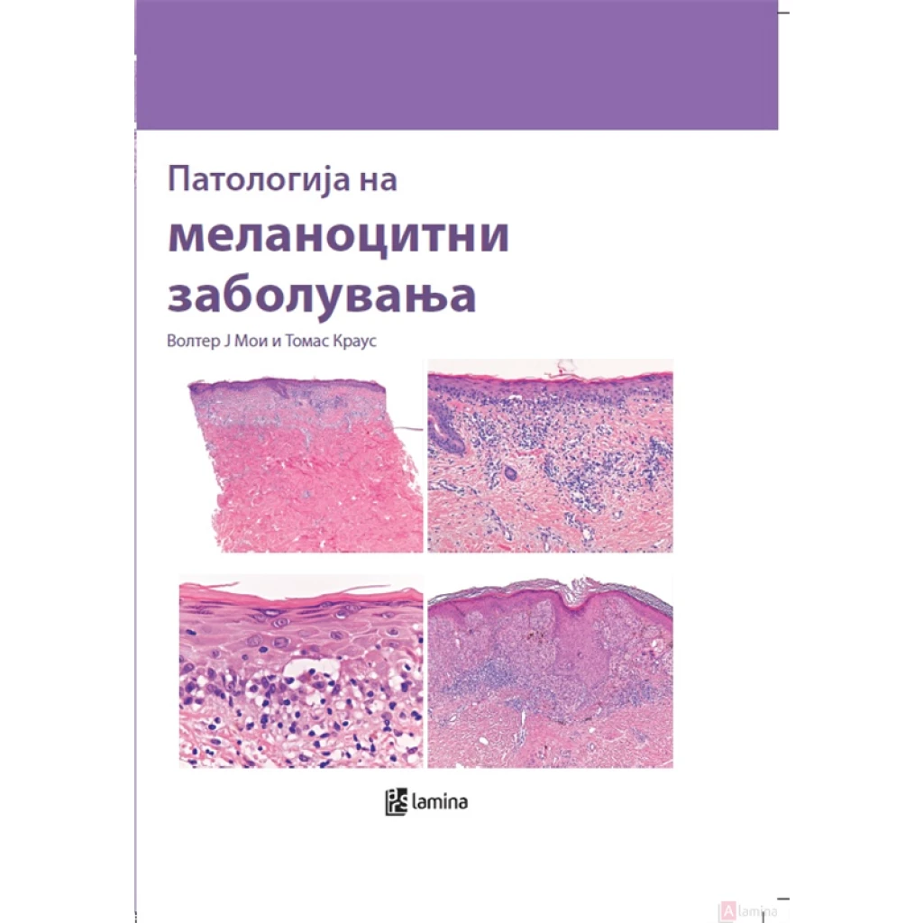 Патологија на меланоцитни заболувања Медицина Kiwi.mk